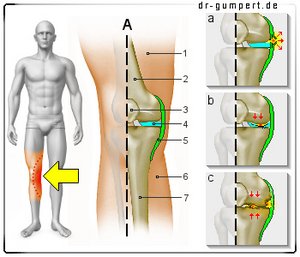 Abbildung Knieschmerzen auf der Innenseite