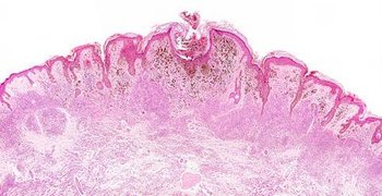 Symtpome Hautkrebs Hautkrebs Symptome