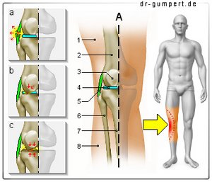 Abbildung Knieschmerzen auf der Außenseite
