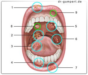 Vom blasen halsschmerzen Mandelentzündung (Tonsillitis)