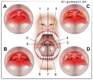 Abbildung Mandelentzündung