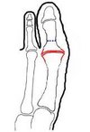 Arthrodese