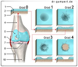 Abbildung Knorpelschaden
