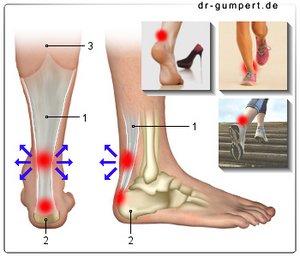 Abbildung Achillessehnenentzündung