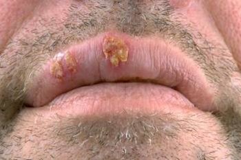 Symptome Herpes