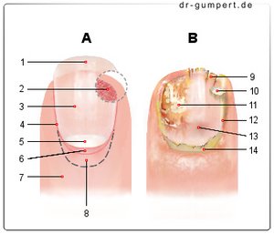 Abbildung eine gesunden und erkrankten Nagels