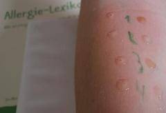 Allergie und ADHS