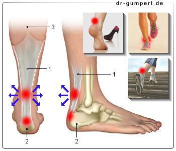 Abbildung Achillessehnenentzündung