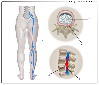 Abbildung Ischiasnerv