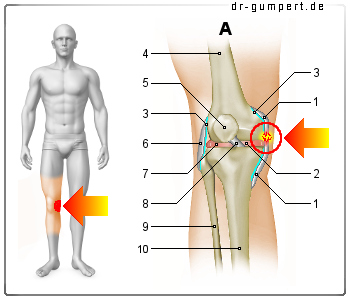 Abbildung Innenbandriss am Knie