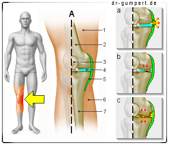 Knickt nach weg knie hinten Rechtes Knie