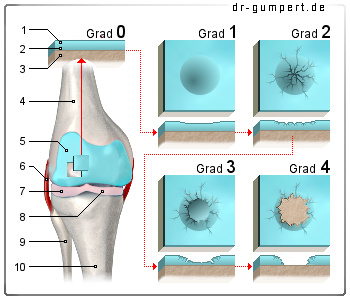 Abbildung Knorpelschaden