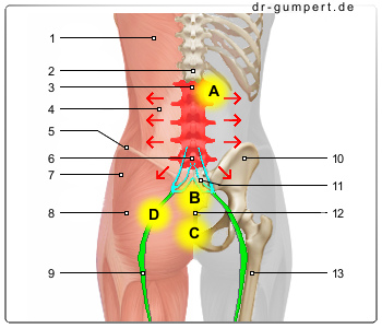 Abbildung LWS-Syndrom (weiblicher Rücken)