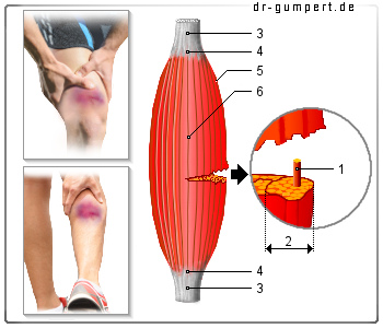 Abbildung Muskelbündelriss