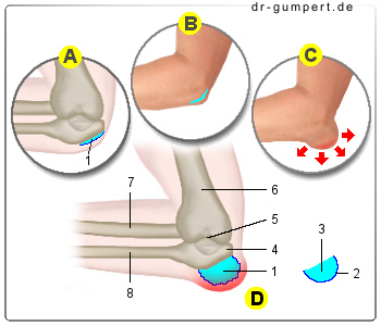 Abbildung Schleimbeutelentzündung Ellenbogen