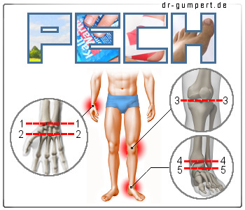 PECH - Schema PECH - Schema