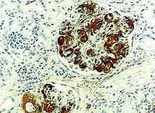 Amyloid