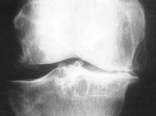 mediale Gonarthrose