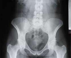 Röntgenbild vom Steißbein