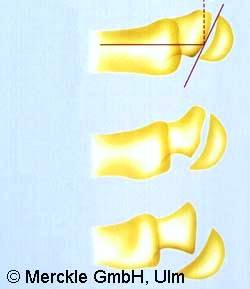 Epiphysiolysis