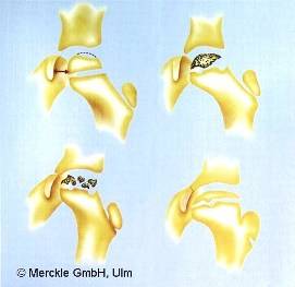 Morbus Perthes Stadien Morbus Perthes Stadien