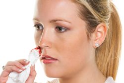 Therapie vom Nasenbluten Therapie vom Nasenbluten