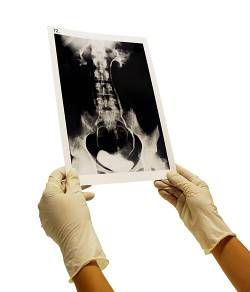 Osteogenesis imperfecta