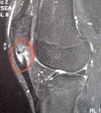 Patellaspitzensyndrom