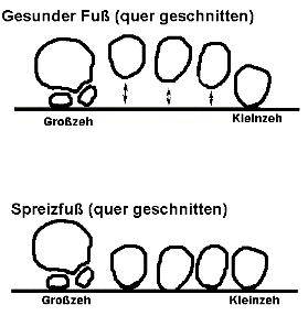 Spreizfuß