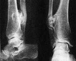 Osteochondrom Schienbein