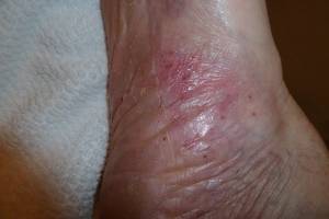 Psoriasis vulgaris