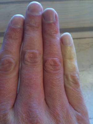 Raynaud-Syndrom