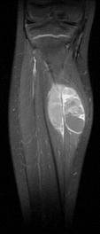 Rhabdomyosarkom der Wade